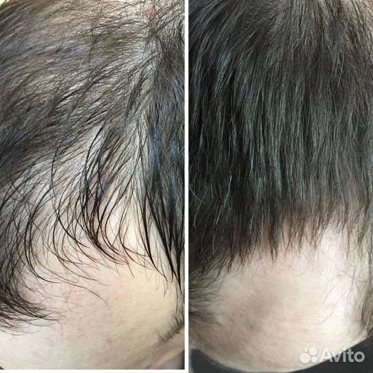 Восстановление и увеличение роста волос