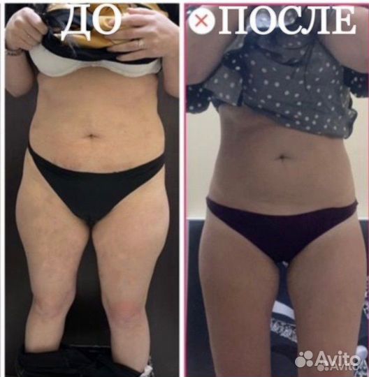 Массаж, Антицеллюлитный массаж