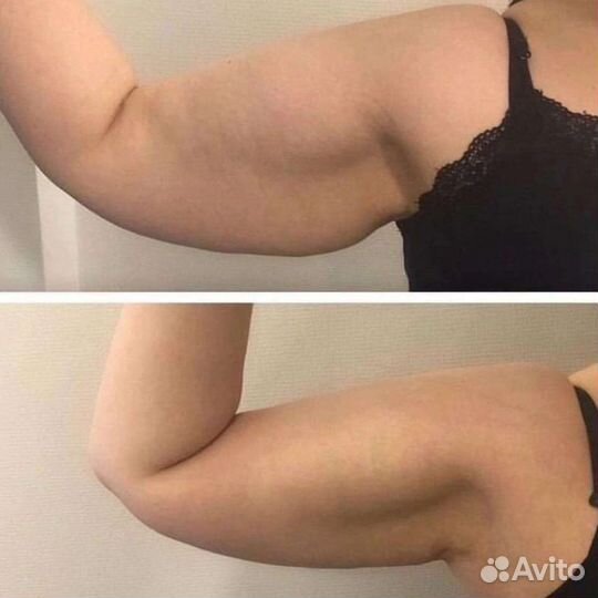 Кавитация горячий вакуум липолитики