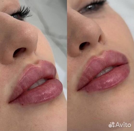 Контурная пластика губ