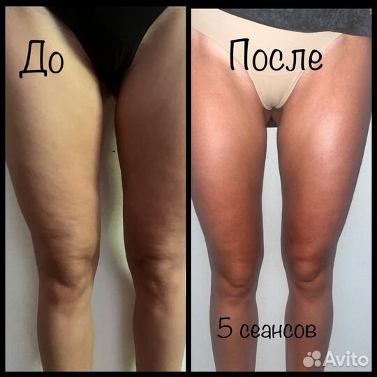 Лимфодренажный, антицеллюлитный массаж, классика