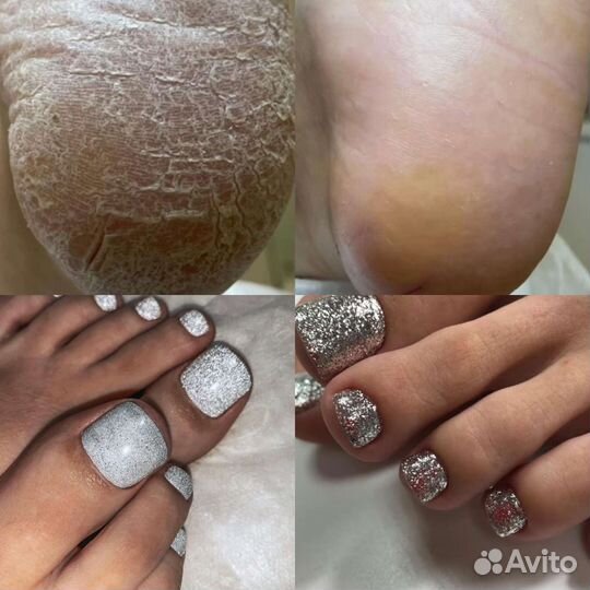 Педикюр. Лечебный педикюр