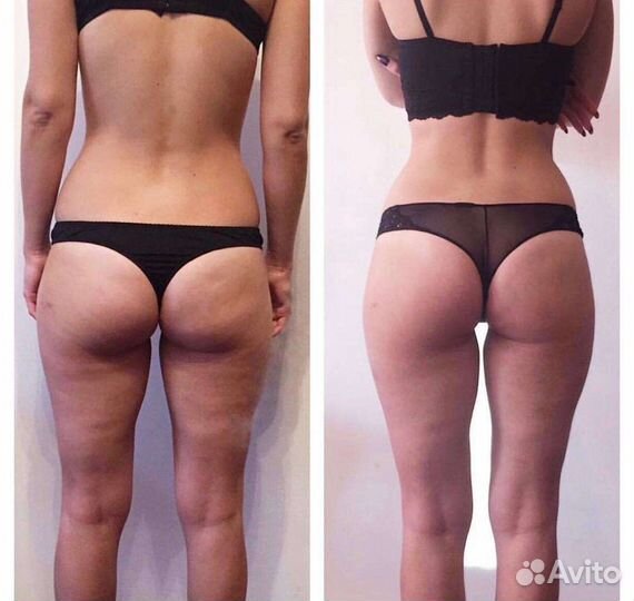 Антицеллюлитный массаж