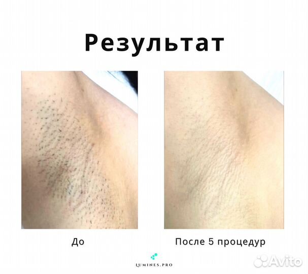 Диодный лазер для эпиляции люминес MaxOne 1200в