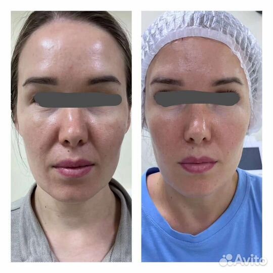 Микроигальчатый РФ лифтинг