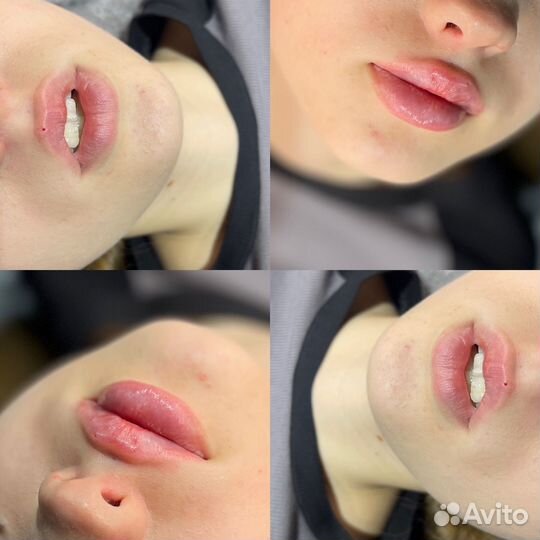 Аугментация губ