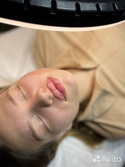 Аугментация губ