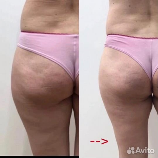 Массаж коррекция фигуры