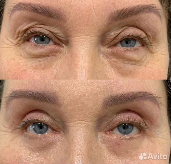 Блеферопластика