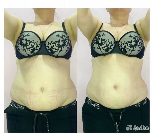 Липосакция без операции в Ростове на Дону