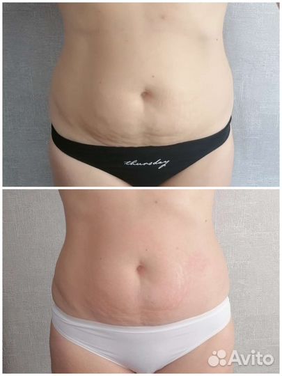 Коррекция тела и лица по технологии indiba индиба